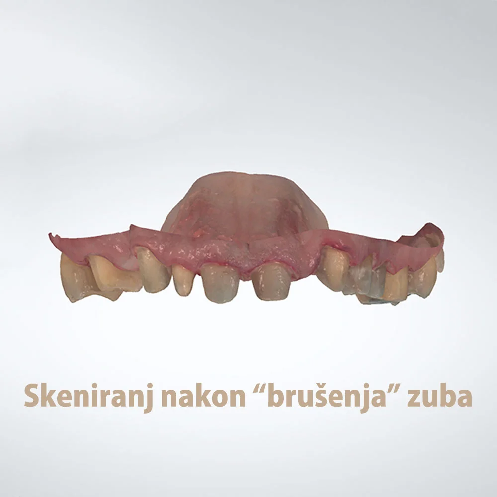Skeniranje nakon brušenja zuba, Vogdent