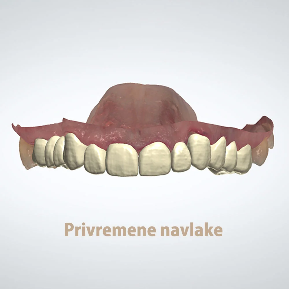 Privremene navlake, Vogdent