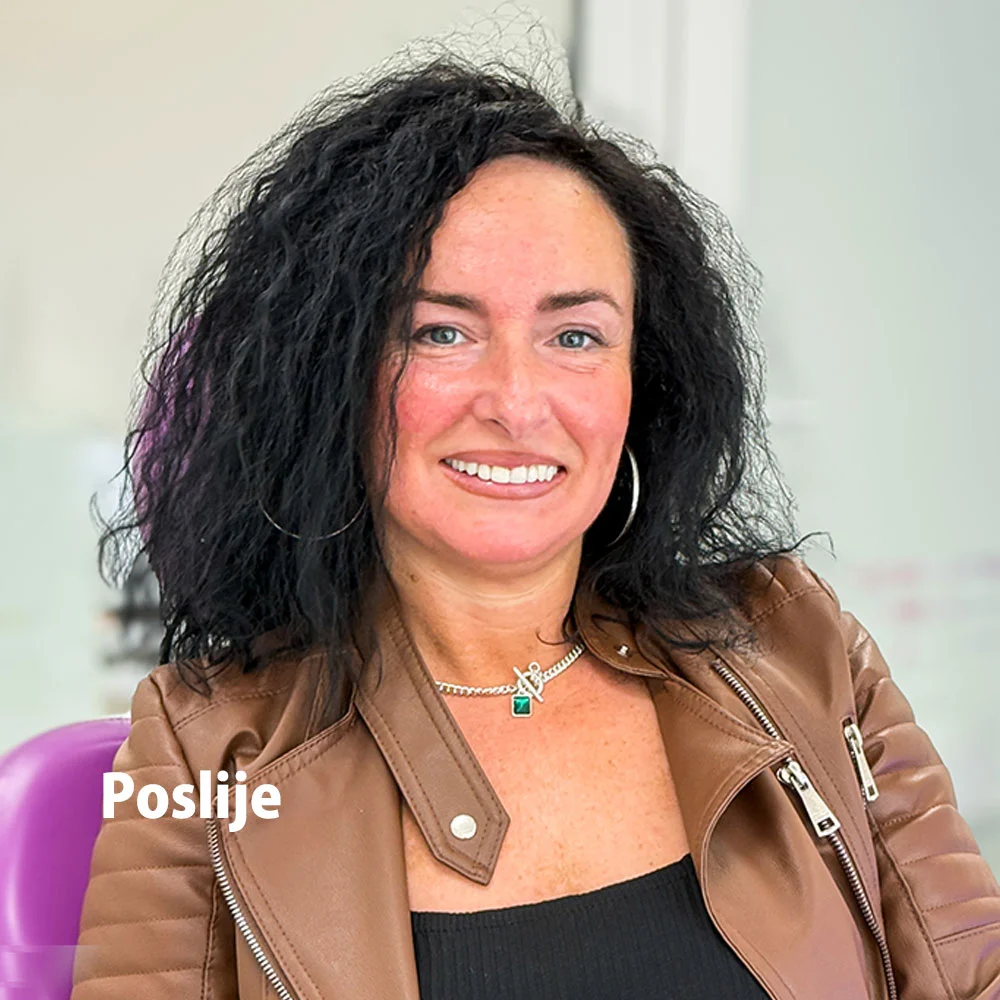 Poslije cirkonskih navlak — finalni rezultat, Vogdent
